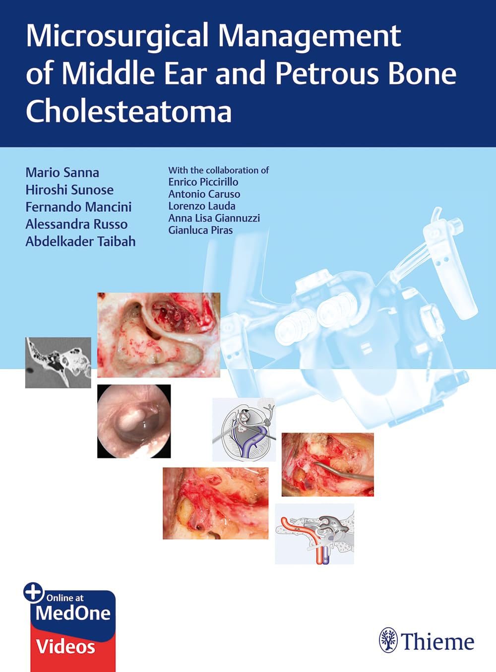 Microsurgical Management of Middle Ear and Petrous Bone Cholesteatoma - Advanced ENT Surgical Techniques for Ear Disease Treatment | Ideal for Otologists and ENT Specialists in Clinical Practice