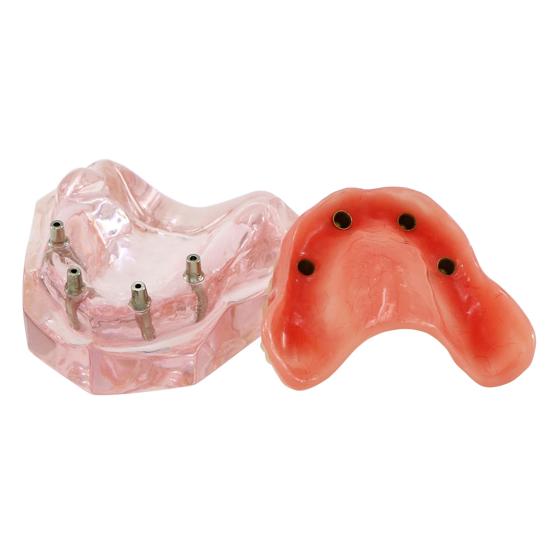 Dental Implant Typodont Model M6001 - Pink Upper Jaw Overdenture with 4 Implants for Superior Restoration | Ideal for Dental Students, Teaching & Clinical Practice
