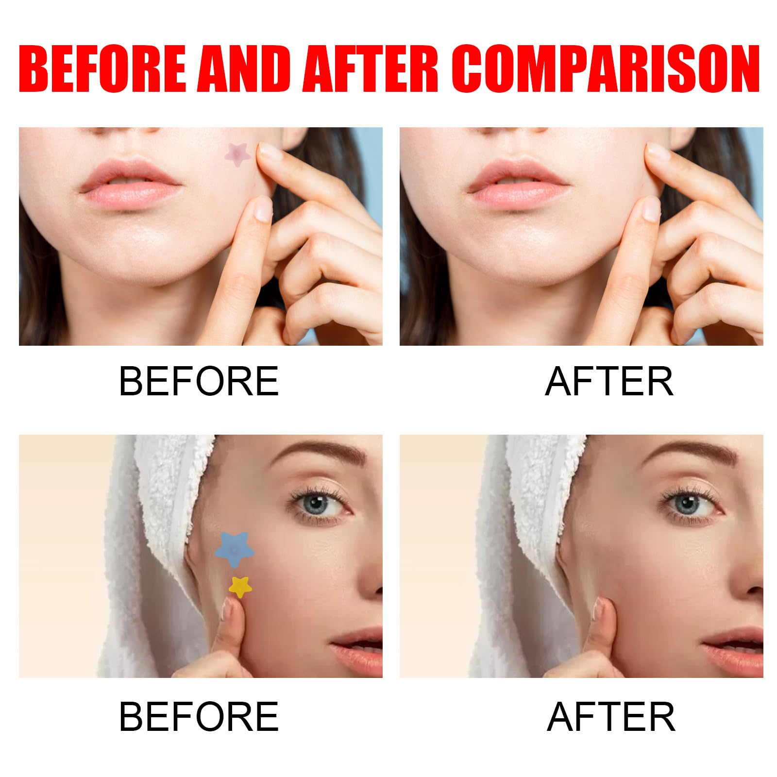 Louatui Star Shaped Hydrocolloid Acne Patches - 400 Pcs Pimple Patches for Face, Zit Absorbing Spot Treatment, Skin Care Stickers (2 Packs) - Perfect for Overnight Acne Treatment & Daily Blemish Cover