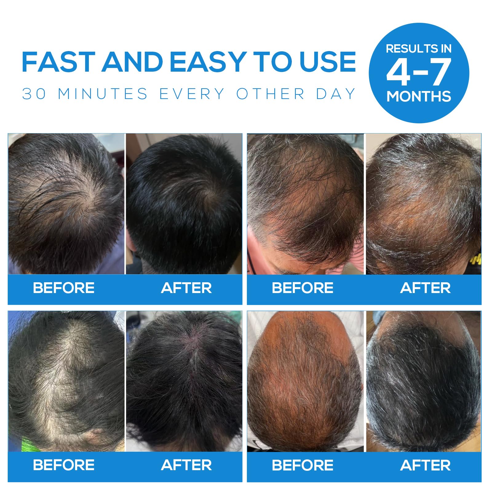 Laser Hair Growth Cap for Women & Men - FDA Cleared Low Level Laser Therapy (LLLT) Device to Stimulate Hair Regrowth - Perfect for Home Use & Hair Loss Treatment