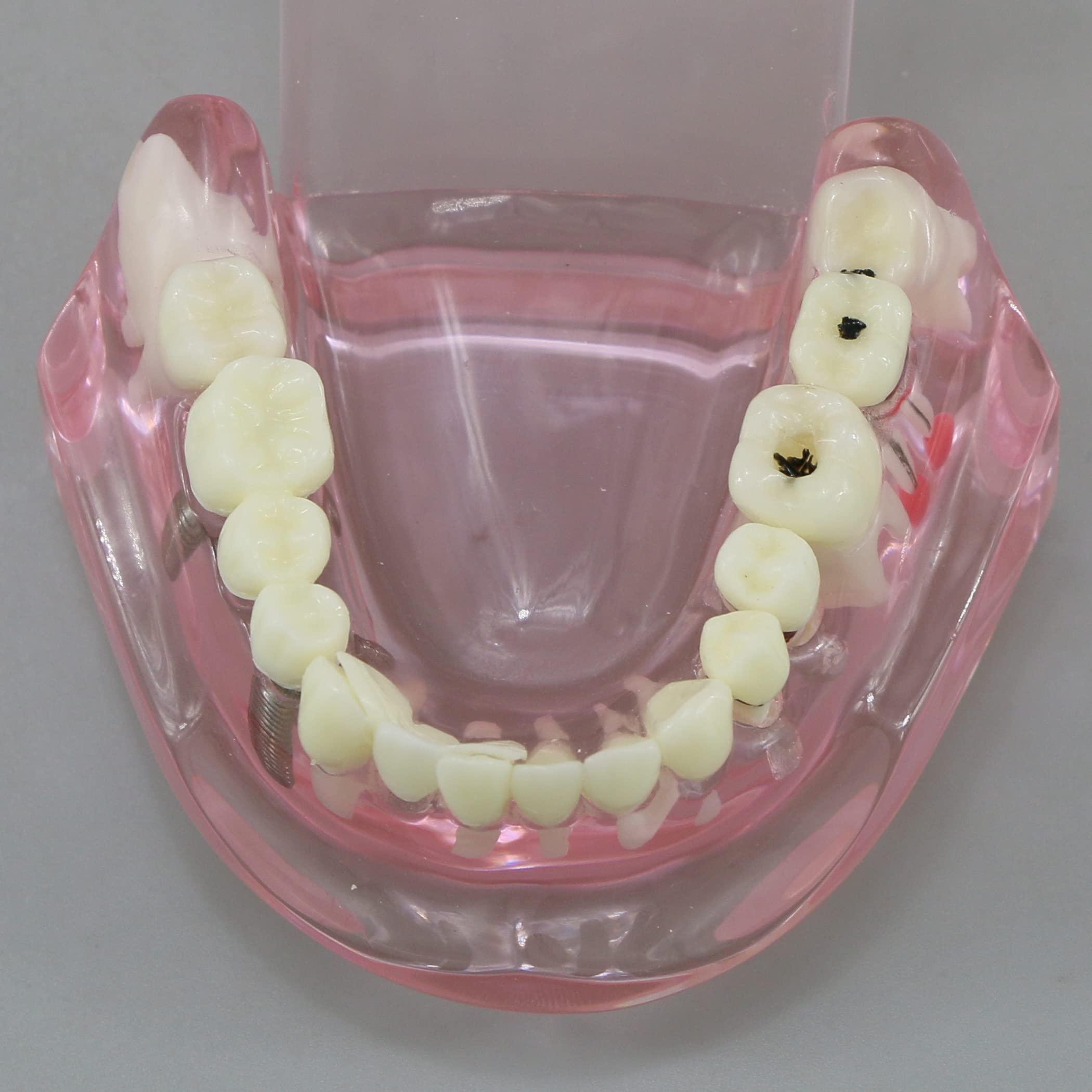 Dental Teeth Model - Implant Restoration Bridge Typodont for Dental Teaching & Study - Oral Pathology Demonstration (M2001 Pink) - Perfect for Dental Schools, Clinics & Training Labs