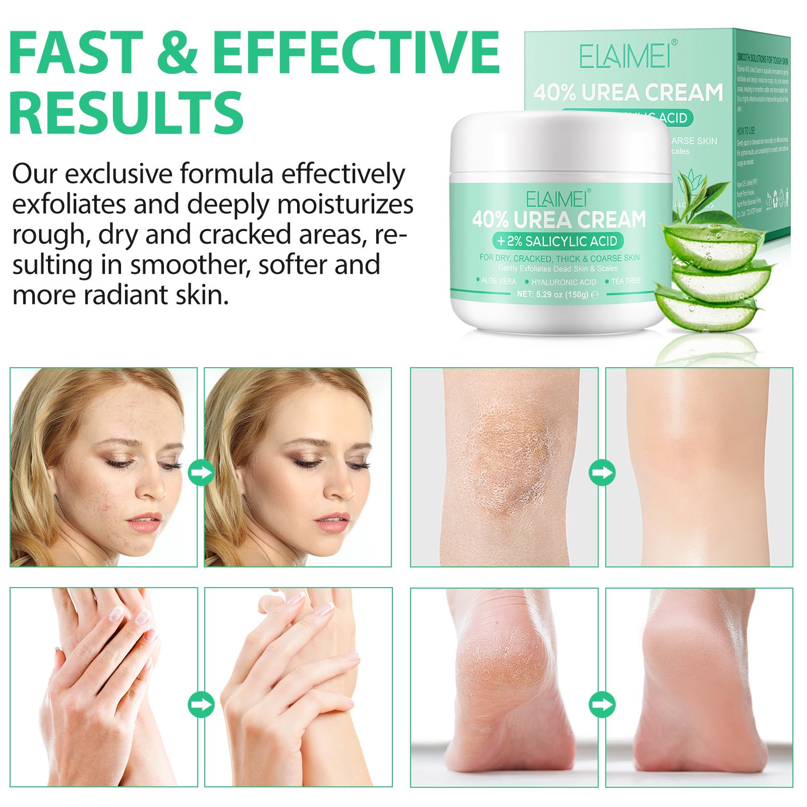 40% Urea Cream for Feet & Hands - Maximum Strength Foot Cream with 2% Salicylic Acid, Hyaluronic Acid, Tea Tree & Aloe Vera - 5.29 oz (150g) - Deep Moisturizing Treatment for Cracked Heels, Dry Skin & Calluses - Ideal for Daily Foot Care & Pedicures