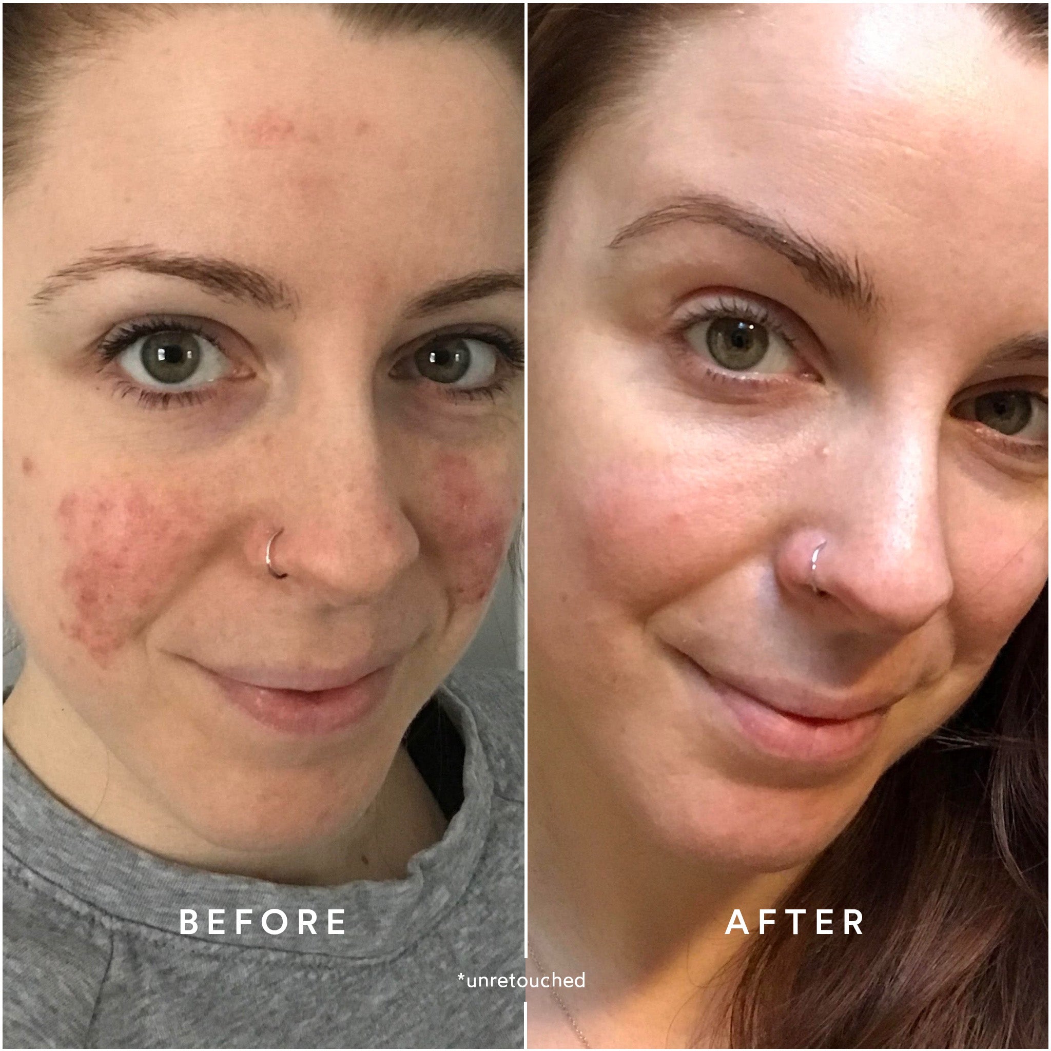 CLEAR Repair Nightly Treatment for Acne & Blemishes - Gentle Overnight Skincare Solution for Clear, Healthy Skin - Perfect for Nighttime Routine & Travel