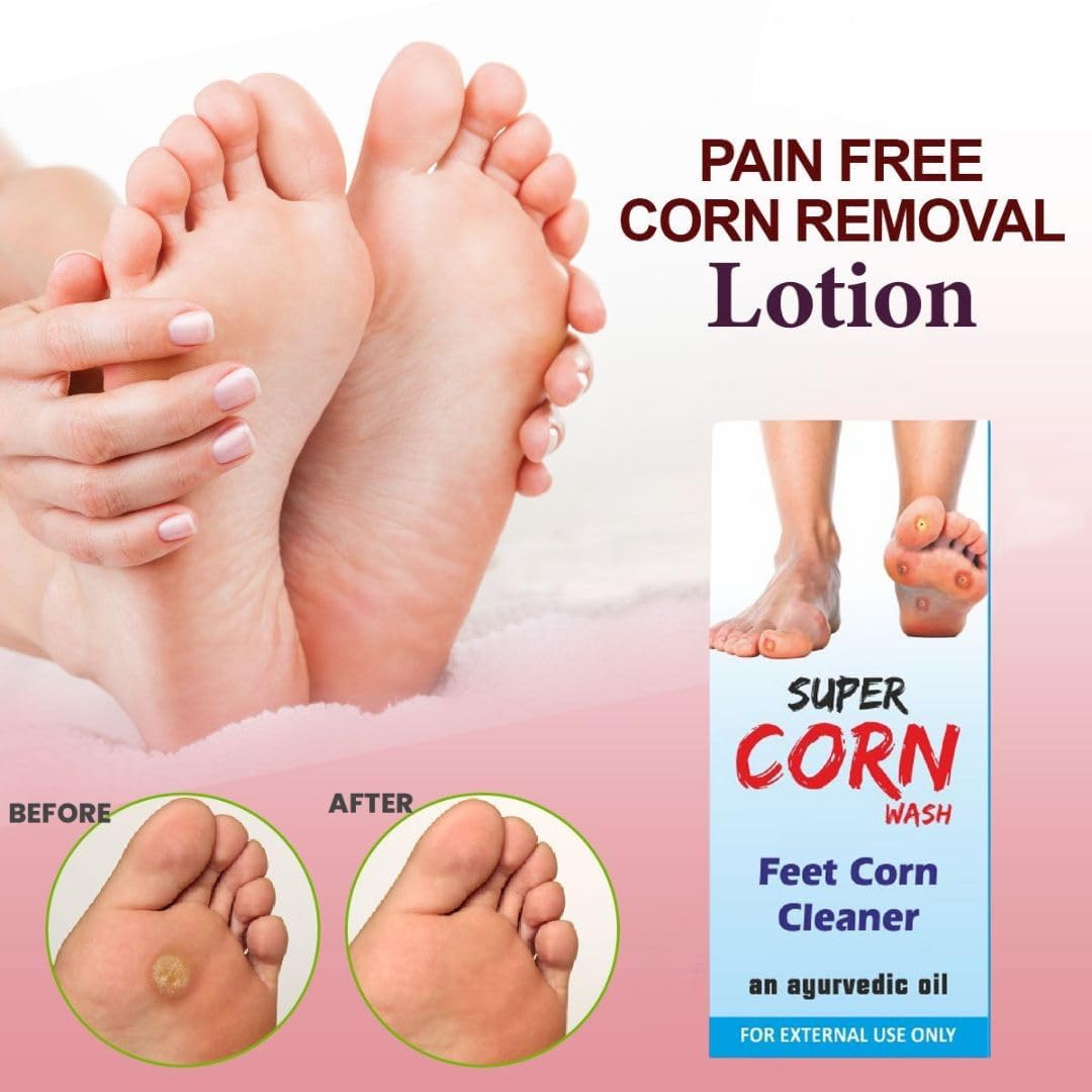 Super Corn Wash Callus Remover - 20ml Ayurvedic Foot Care Oil for Smooth Feet, Hard Skin & Plantar Wart Treatment | Natural Ingredients | Perfect for Pedicures, Cracked Heels & Dry Skin Relief