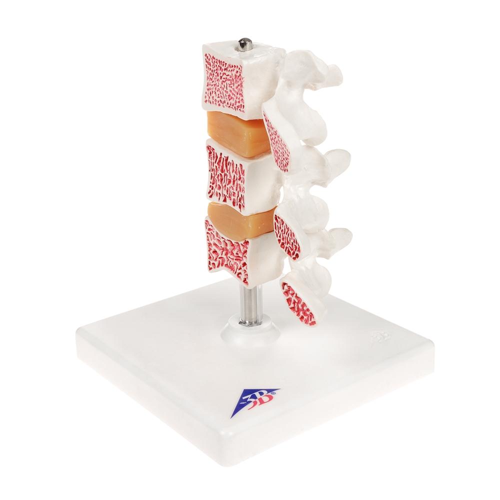 Premium Osteoporosis Bone Model - Anatomically Accurate Skeletal Display for Medical Education & Patient Demonstration - Perfect for Classrooms, Clinics, and Healthcare Training