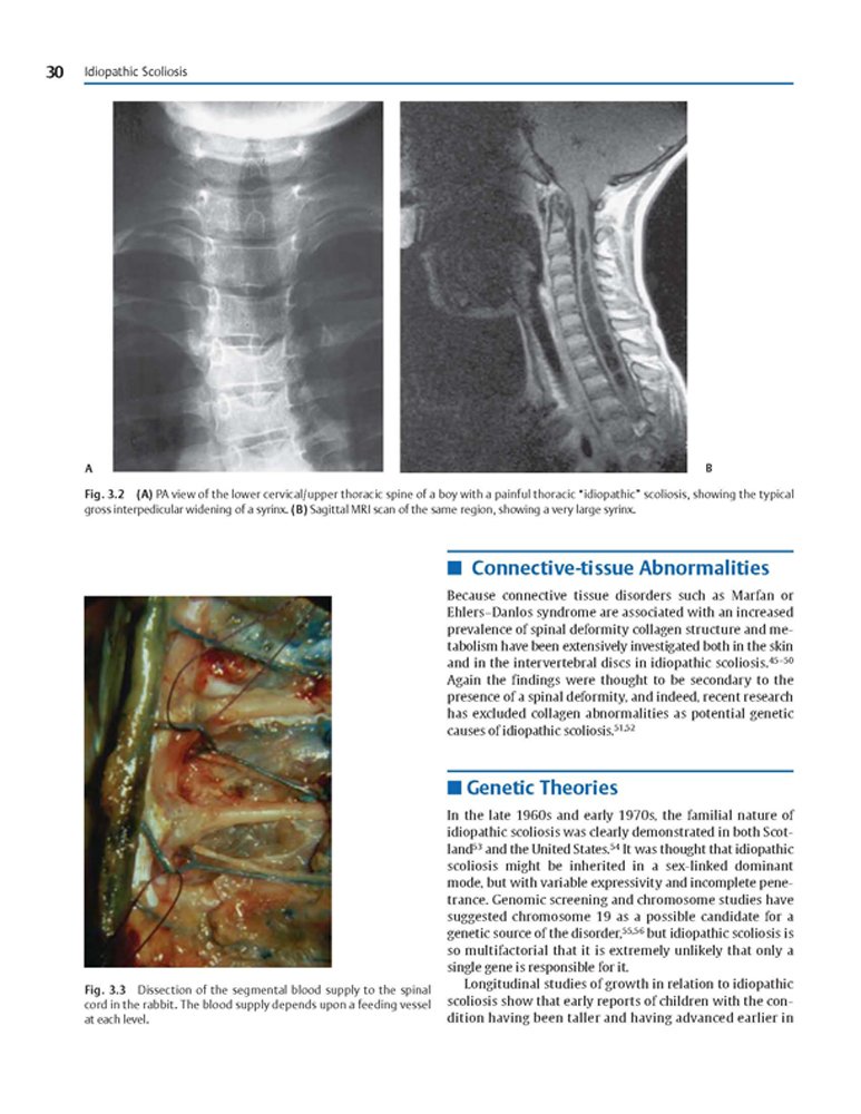 Idiopathic Scoliosis Treatment Guide - Harms Study Group Recommendations for Spinal Correction & Pain Relief | For Doctors, Physical Therapists & Patients