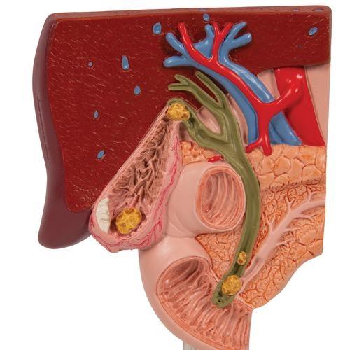Gallstone Model with 3B Smart Anatomy K26 - Medical Teaching Tool for Human Digestive System Study & Classroom Demonstration