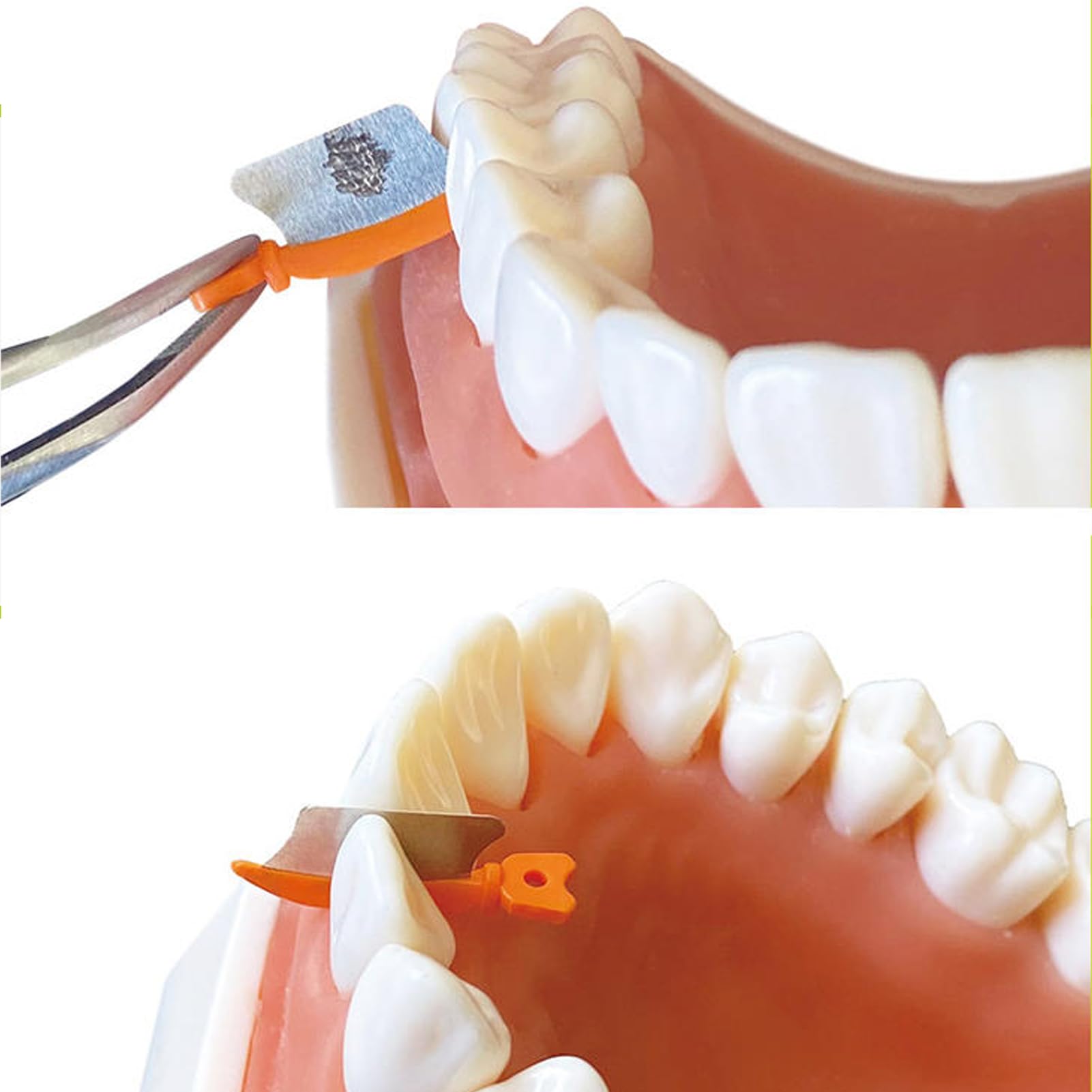 Dental Wedge Knife & Interproximal Plastic Wedges - Orthodontic Matrix Wedges for Teeth with Metal Guard (Purple, Large) - Perfect for Dental Procedures, Teeth Separation & Interproximal Restoration