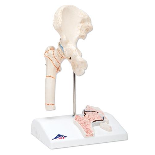 Femoral Fracture & Hip Osteoarthritis Anatomical Model - Medical Training, Student Education, and Clinical Demonstration Tool