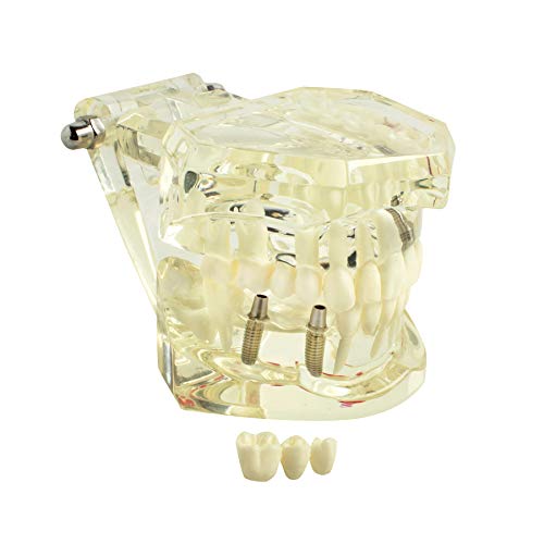 Dental Implant Model with Removable Teeth - Oral Pathology Teaching Demo for Implantology & Bridge Restoration - Perfect for Dental Students & Professionals (Study, Training, Practice)