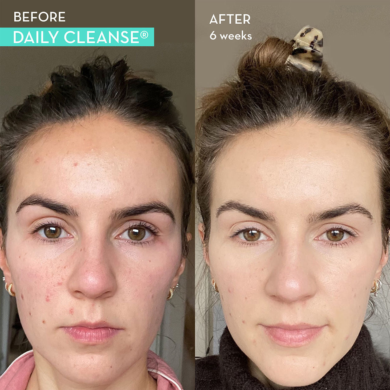 Best Daily Cleanse Clear Skin & Acne Supplement for Adults - Natural Skin Care Vitamins for Face Breakouts & Blemish Control - Perfect for Morning Routine & Teenage Skin Care