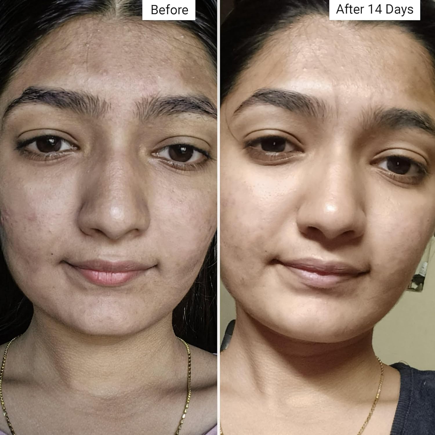 Renew Gentle Skin Cleanser with Salicylic Acid for Acne-Prone Skin - 100ml | Prevents Breakouts & Clears Pores | Perfect for Daily Face Wash Routine