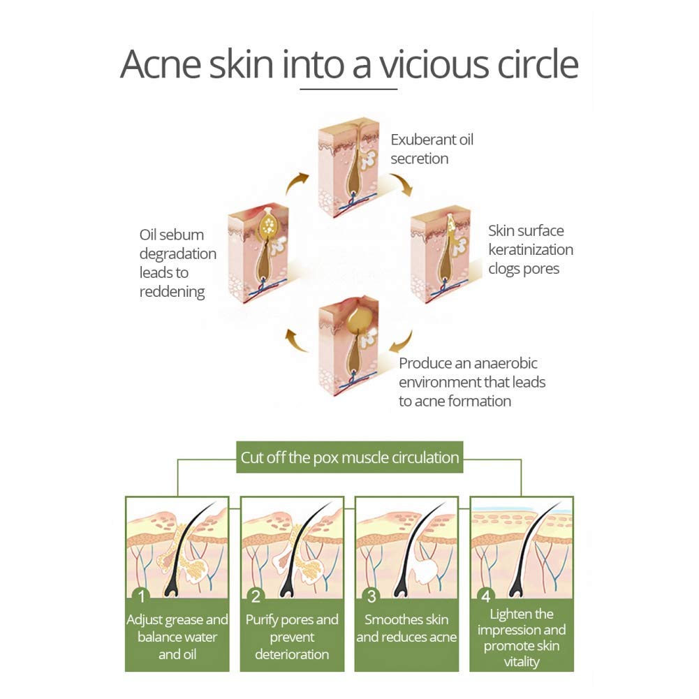 Tea Tree Anti Acne Facial Cream - Pore Minimizer & Blemish Treatment - Oil Control & Pimple Removal - 30g - Perfect for Oily & Acne-Prone Skin - Day & Night Skincare Routine