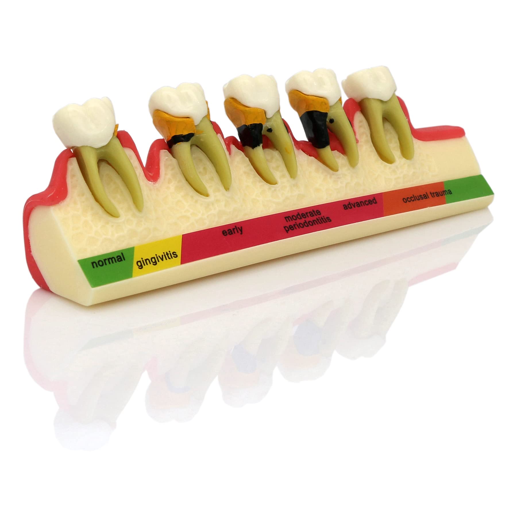 Dental Typodont Teeth Model for Adults & Children - Pathological Demonstration for Teaching & Studying (M4010) | Ideal for Dental Schools, Training & Clinical Practice