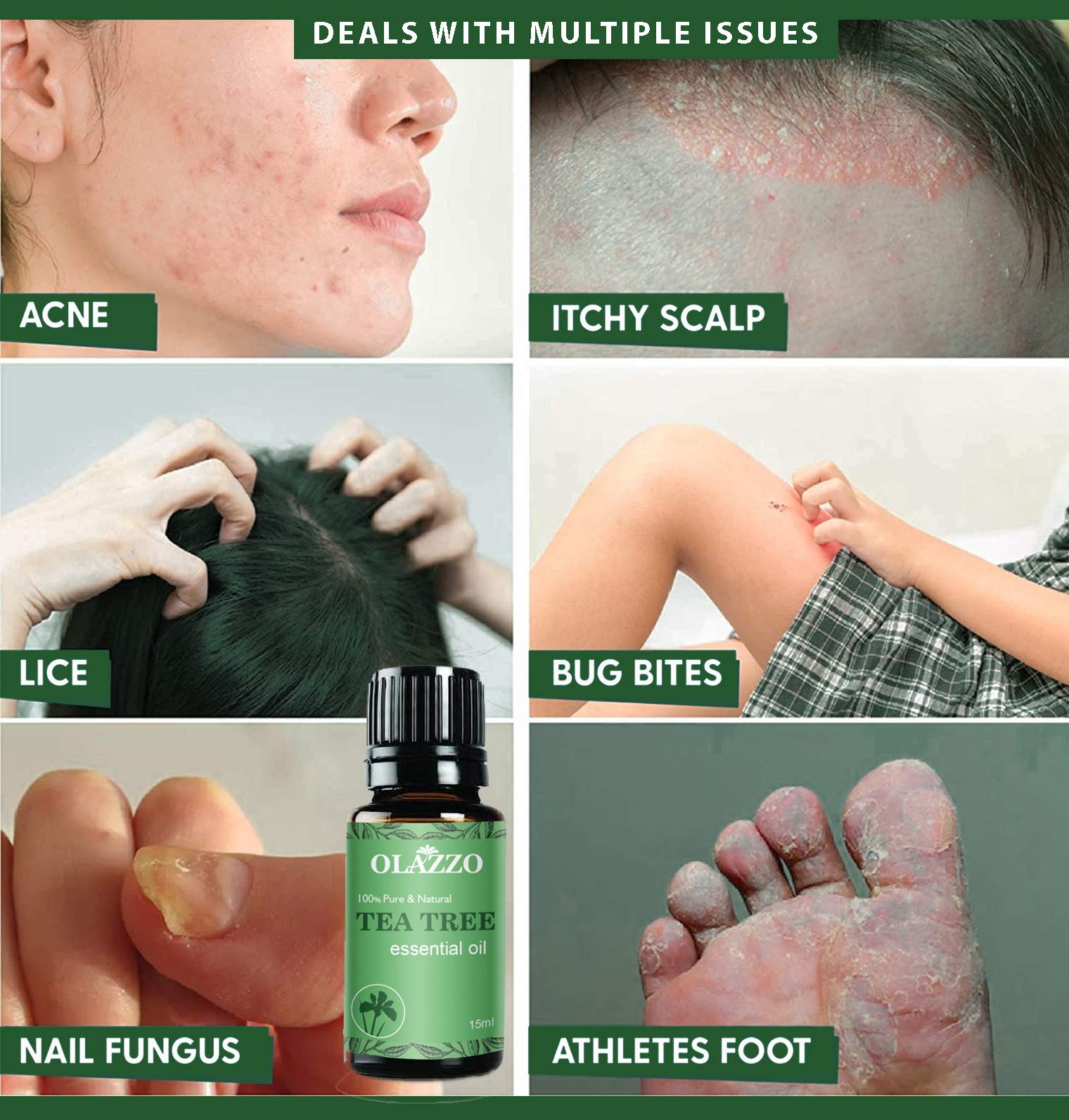 Pure Tea Tree Essential Oil for Skin, Hair & Nails - 100% Natural Steam Distilled Treatment for Acne, Dandruff & Healthy Toenails | 30ml Organic Oil for Face Care, Hair Growth & Foot Health