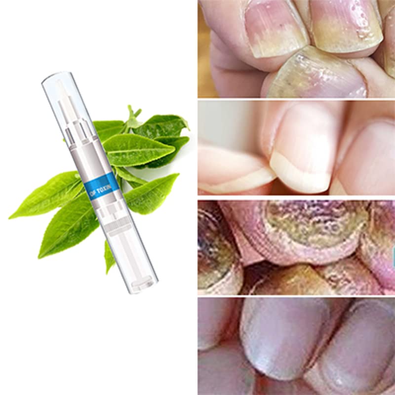 PerfectBuy 3ML Nail Fungus Treatment - Fast-Acting Antifungal Solution for Toenail & Fingernail Infections - Doctor Recommended for Home Use & Daily Foot Care