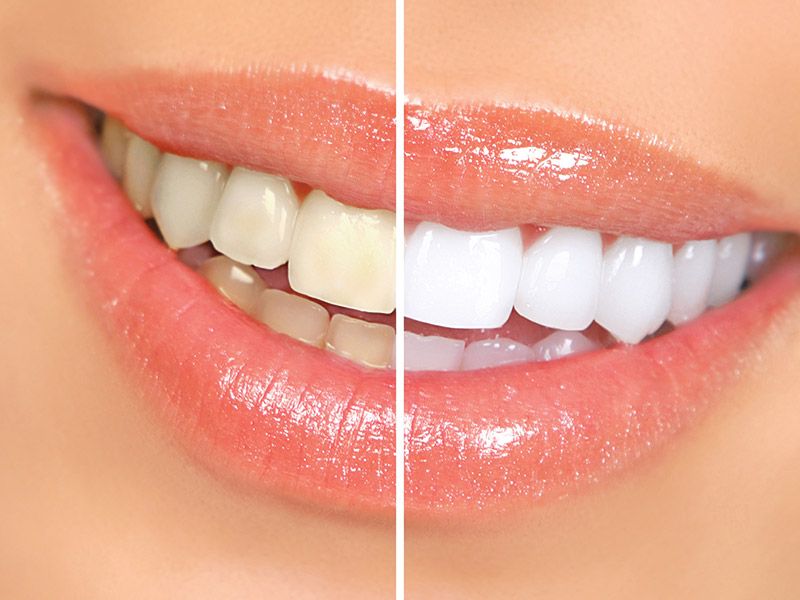 Innovawhite Teeth Whitening Kit - Professional Teeth Whitening Pen & LED Light for Brighter Smile - At-Home Teeth Whitening Solution for Coffee, Wine & Smoking Stains | Perfect for Travel, Gifts & Daily Use
