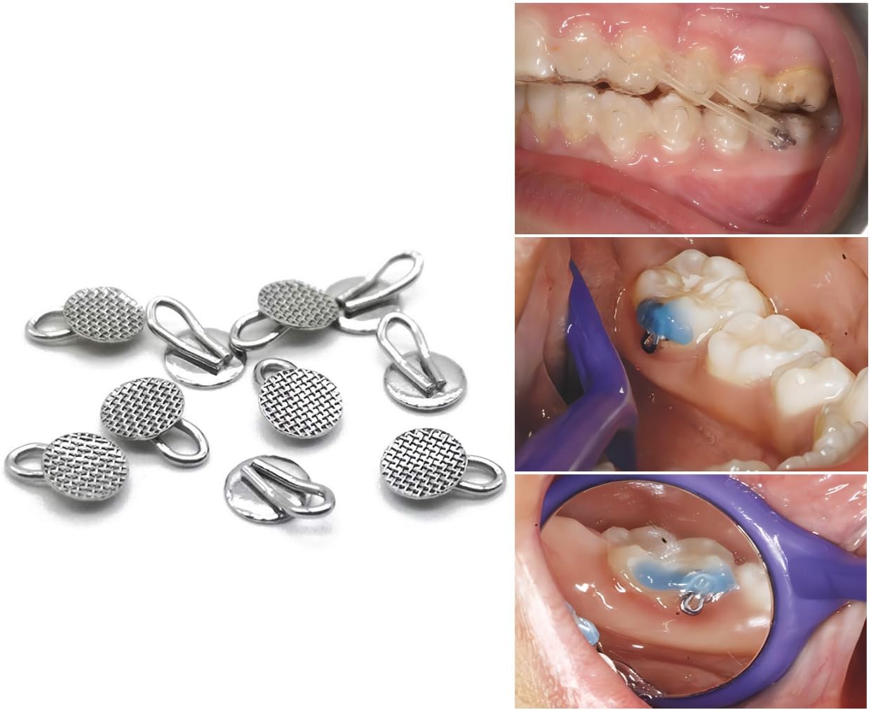 Orthodontic Braces Bondable Lingual Buttons with Traction Hooks - 10pcs/Pack, Mesh Base (5 Packs) - Perfect for Dental Alignment & Orthodontic Treatment