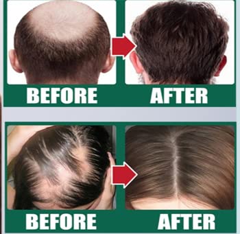 Best Hair Growth Serum for Women & Men - Natural Hair Regrowth Treatment with Biotin & Keratin - Stimulates Thicker, Longer Hair for Daily Use & Scalp Care