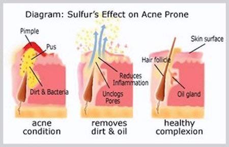 JOESOEF Sulfur Soap for Acne Treatment - 100g Facial Cleanser with Sulfur for Acne-Prone Skin (4-Pack) | Helps Clear Breakouts & Blackheads - Ideal for Daily Face Wash & Body Care