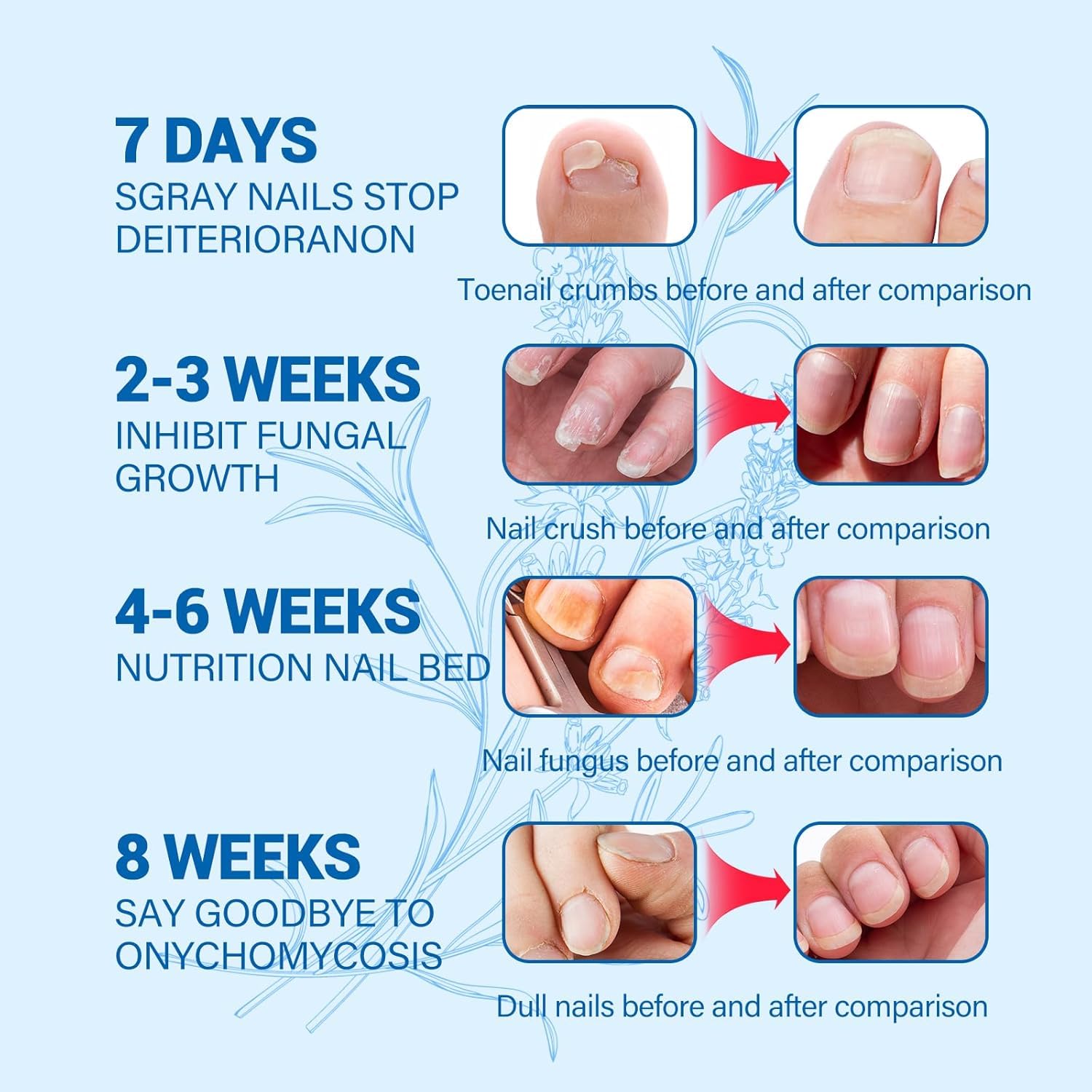 Extra Strength Toenail Fungus Treatment for Fingernails & Toenails - Safe & Gentle Nail Repair Solution with Nail Softener (30ml) - Ideal for Athletes, Pedicures & Daily Foot Care