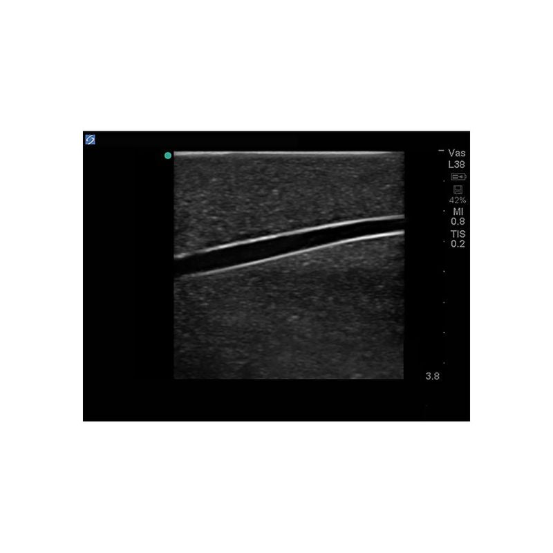 Gen II Central Line and Regional Anesthesia Replacement Insert - Sterile Medical Catheter for IV Therapy & Pain Management in Hospitals & Clinics