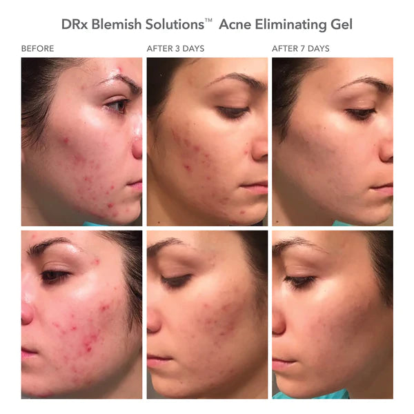 DRx Blemish Solutions™ Acne Eliminating Gel - Fast-Acting Acne Treatment for Clear Skin | Perfect for Teen & Adult Acne Care, Breakout Prevention & Oily Skin Control