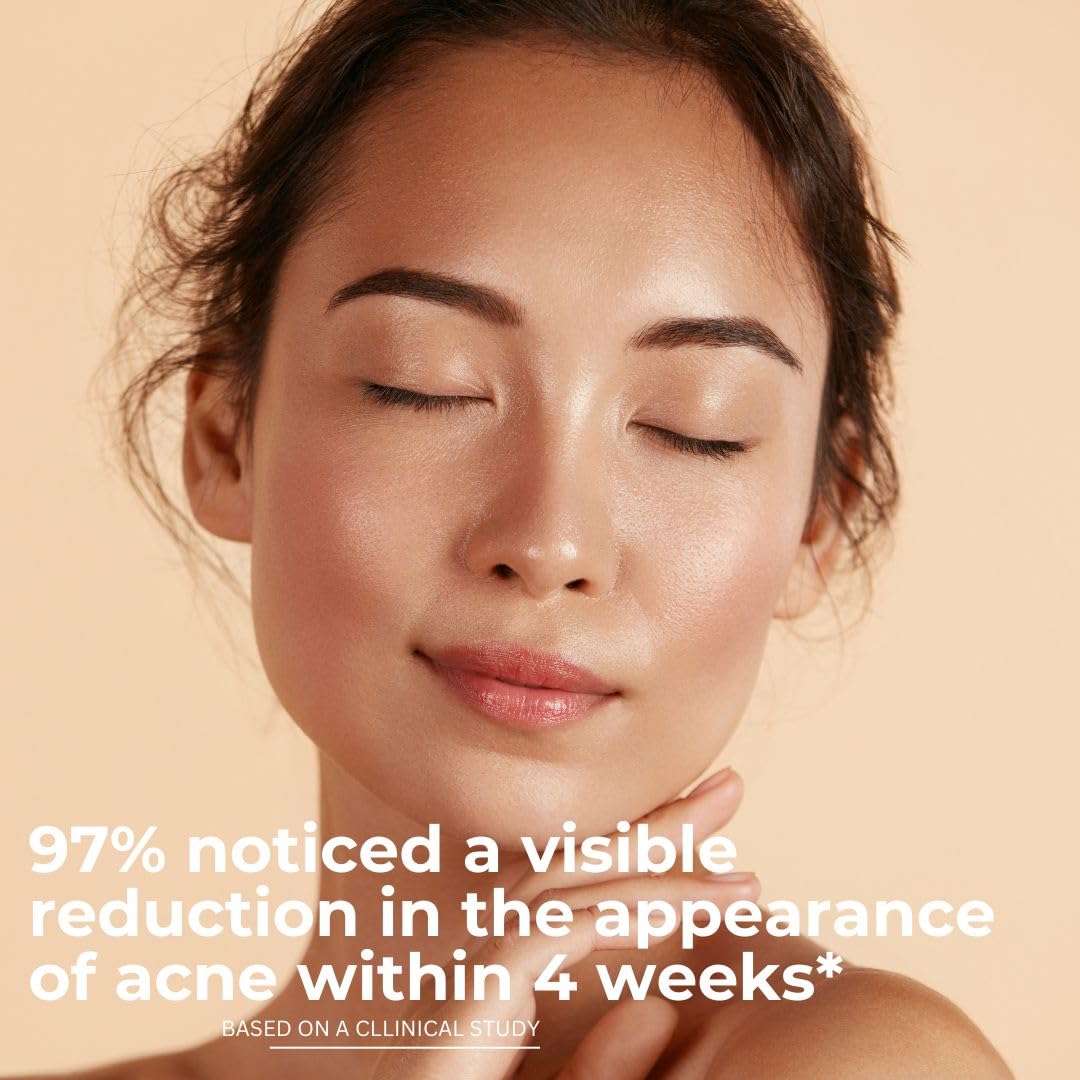 hollywoodskin INTENSE Acne Cream with 2% Salicylic Acid - Overnight Acne Treatment, 400% Stronger Than Regular Acne Creams - 50ml (4 Pack) for Clear Skin - Perfect for Nighttime Use on Face, Back & Body Breakouts
