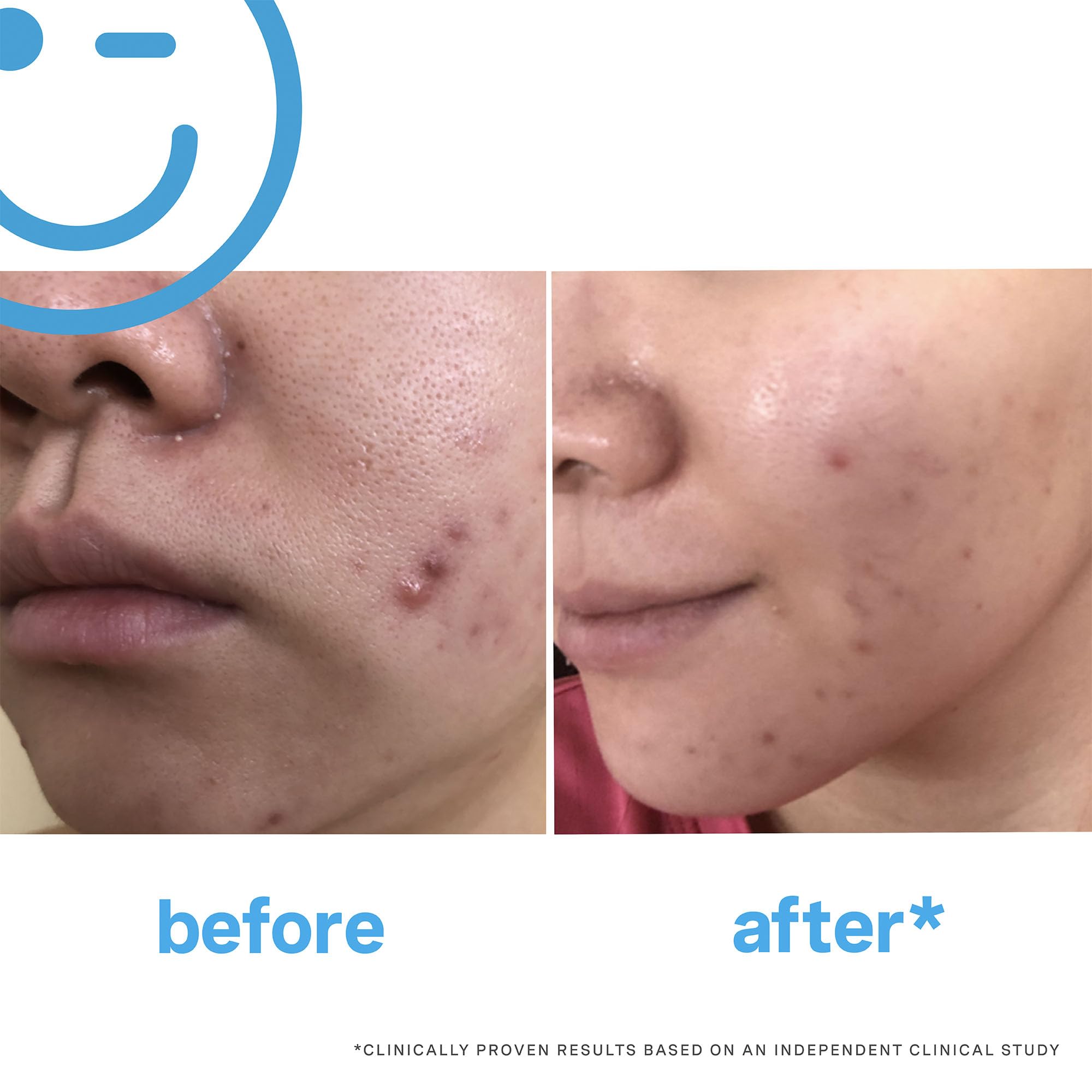 Kate Somerville Breakout Dream Team: EradiKate 3% Sulfur Daily Foaming Cleanser for Acne Treatment (4 oz) & Mega-A Skin Transforming Anti-Aging Serum with Retinal (1 oz) - Perfect for Daily Skincare Routine and Fighting Acne + Wrinkles