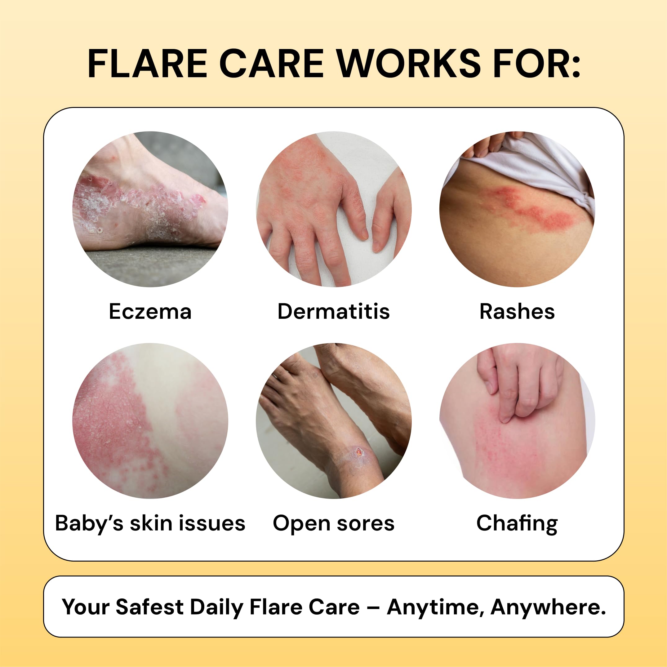 Universal Flare Care - Essential Oil Free Skin Relief for Eczema, Dermatitis, Psoriasis, Rashes & Baby Skin Issues | Propolis & Egg Yolk Formula | Soothes Hidradenitis, Chafing, Sores & Wounds | 1oz | Perfect for Daily Skincare & Sensitive Skin Care Routine