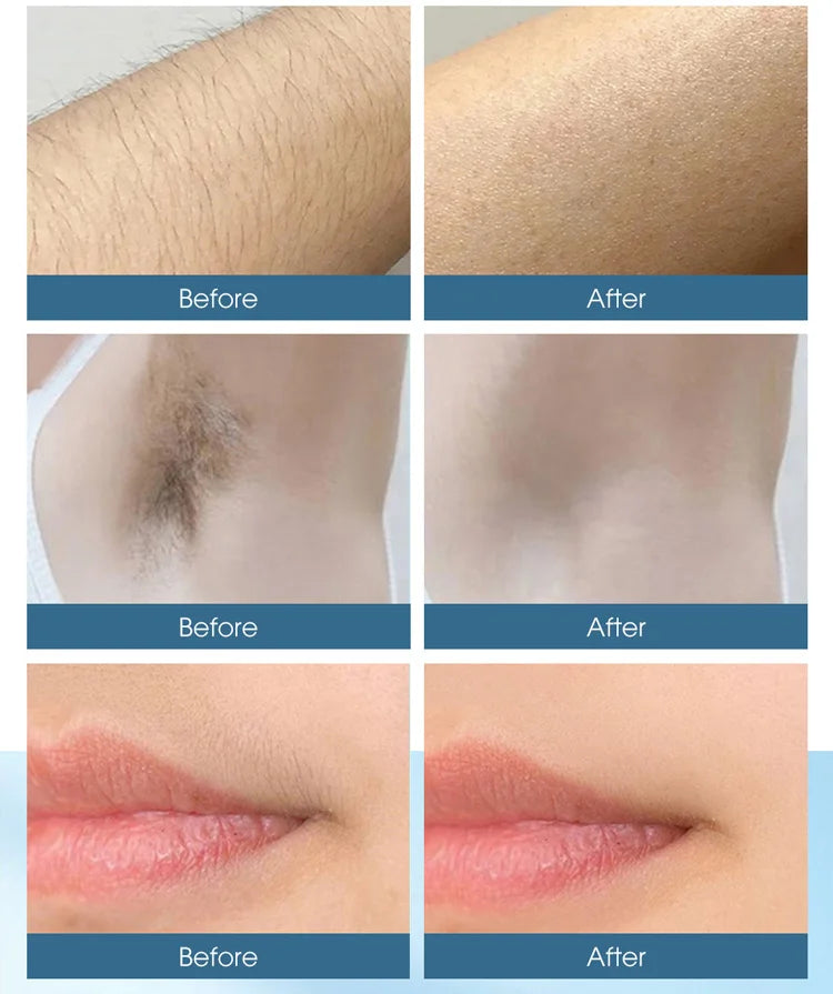 Best IPL Laser Hair Removal Device for Women & Men - Permanent Hair Reduction at Home - Painless & Effective for Legs, Underarms, Bikini Line & Face