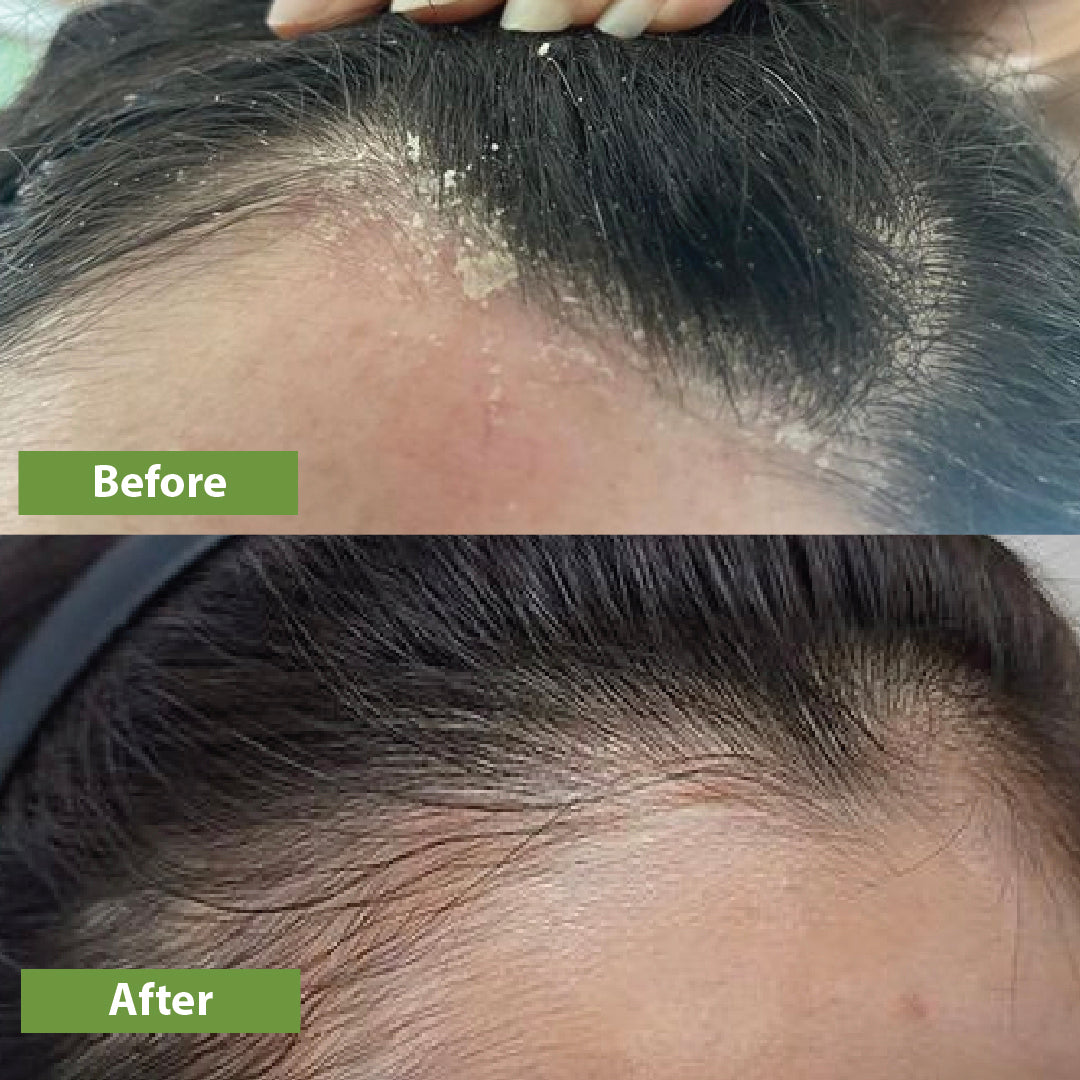 Anti Dandruff Kit for Men & Women - Scalp Treatment & Hair Care Set for Dry, Itchy Scalp - Best for Dandruff Control & Healthy Hair Growth | Home & Travel Use