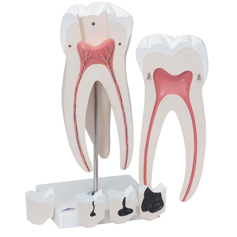Giant Molar with Cavities - 15x Life Size Dental Model (5-Part) - Perfect for Dental Education, Classroom Demonstrations & Medical Training