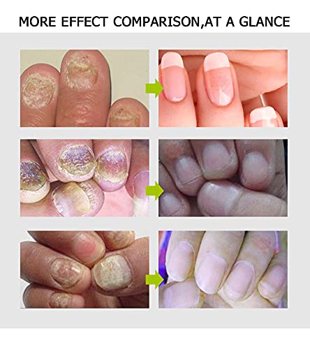 Efero Nail Treatment Repair Gel - Fungal Toenail Treatment, Nail Repair Cream for Yellow, Cracked & Split Nails - Renews Damaged Nails (4PCS) - Perfect for Home Pedicures & Nail Care Routines