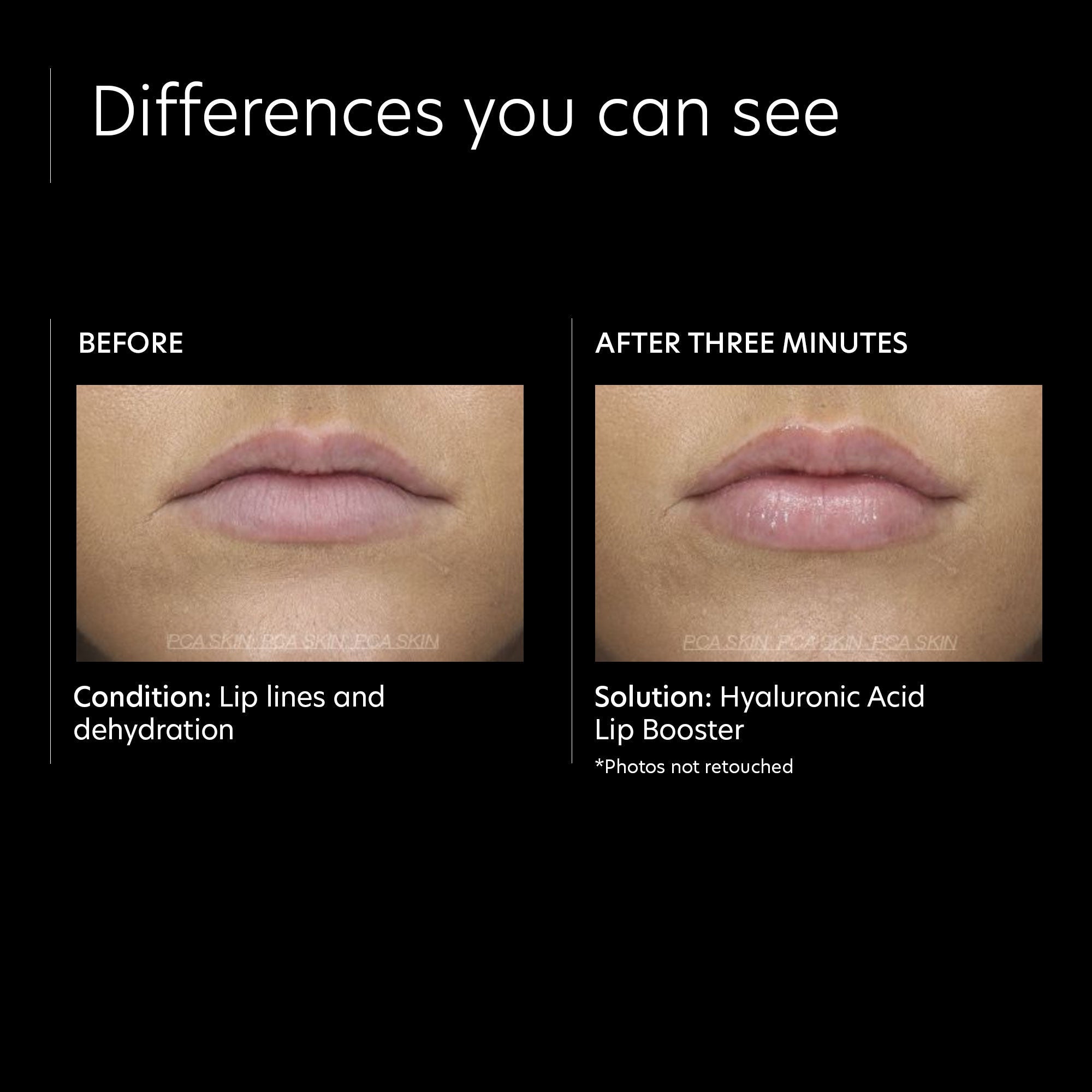 Hyaluronic Acid Lip Plumper for Hydration & Volume - Perfect for Dry Lips & Nighttime Lip Care