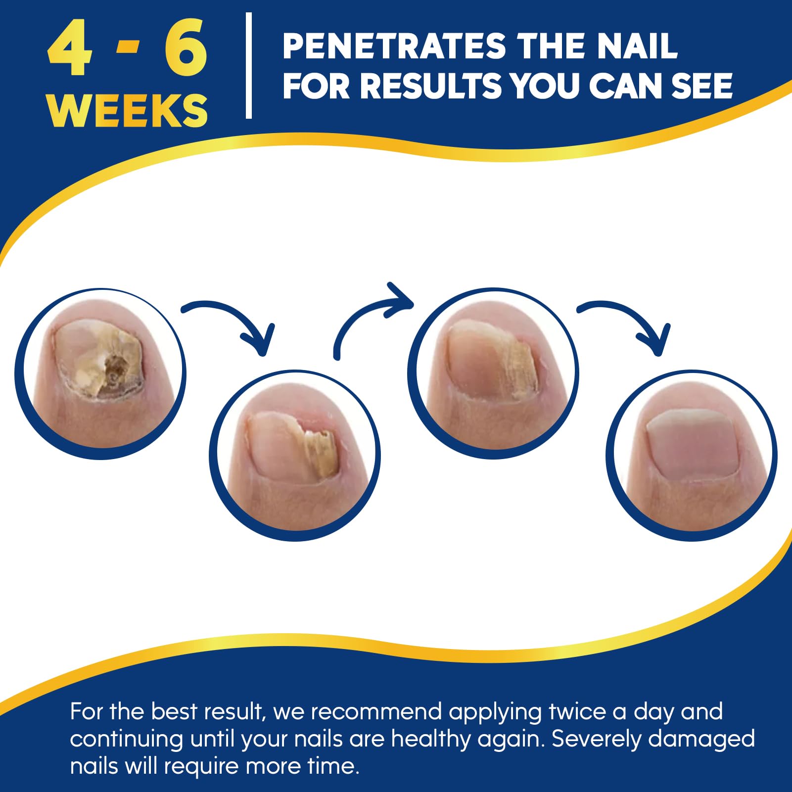 Extra Strength Toenail Repair Treatment with 32 Nail Patches - Fungal Nail Solution for Toenails & Fingernails - Fixes Athlete's Foot, Thickened & Discolored Nails - Ideal for Gym, Pool & Sports Locker Rooms