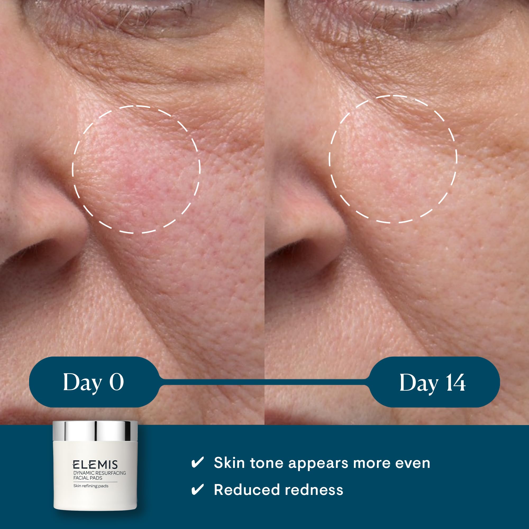 ELEMIS Dynamic Resurfacing Facial Wash & Exfoliating Pads Set - Gentle Face Cleanser & Peel Pads for Smooth Skin - Perfect for Daily Skincare Routine & Travel Skincare Essentials