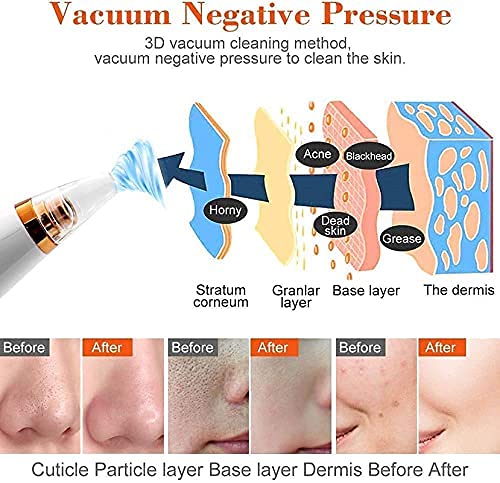 Shraddha Saburi Electric Acne Pore Cleaner - Blackhead Remover Vacuum with ABS Material - Professional Derma Suction Machine for Clear Skin | Perfect for Home Spa & Facial Care Routine