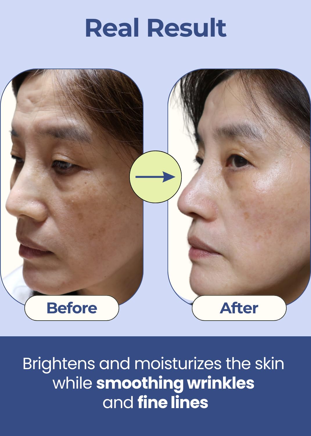 Premium Korean Overnight Wrinkle Patches for Face - Anti-Wrinkle Face Lift Tape with Collagen & Peptides | Reduce Frown Lines, Smile Lines, Forehead Wrinkles & Crow’s Feet | 50 Count | Perfect for Nighttime Skincare & Special Events