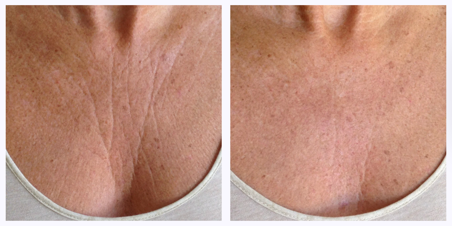Anti-Aging Chest Wrinkle Patches for Women & Men - Reusable Silicone Wrinkle Remover Strips - Reduce Fine Lines & Wrinkles Overnight - Perfect for Nighttime Skincare Routine & Special Occasions
