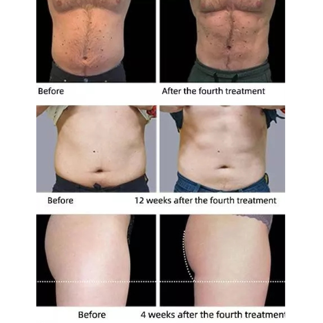 EMShape Neo® Elite Personal Body Sculpting Device - Upgraded High Power for Home & Professional Use - Perfect for Toning, Firming, and Body Contouring