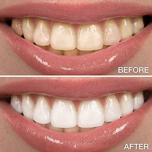 Novashine Teeth Whitening Gel Refill Kit - 4 x 5ml Syringes (3 Month Supply) | Sensitivity-Free Whitening Gel for LED Light | Perfect for Home Teeth Whitening & Brightening Smile