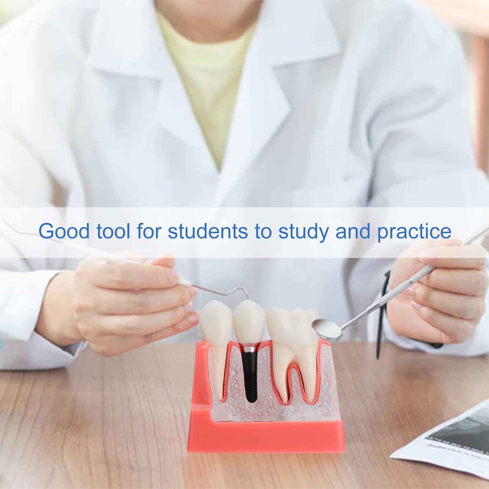 Dental Implant Model - 4X Removable Implant vs Bridge Demonstration Teeth for Dental Education & Practice | Perfect for Dental Students, Professionals & Training Clinics