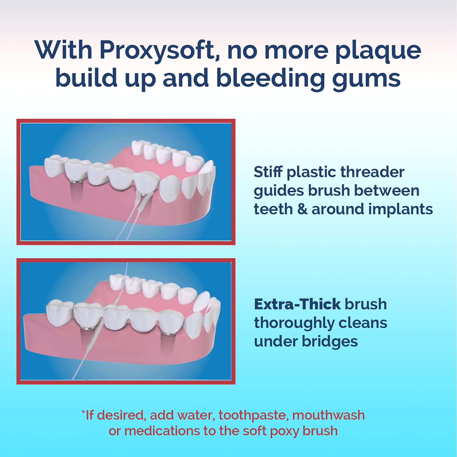 **Proxysoft Dental Floss for Bridges & Implants – 6 Pack Floss Threaders for Dental Bridges, Implants, Braces – Extra-Thick Proxy Brush for Optimal Oral Hygiene – Teeth Bridge & Implant Cleaners – Perfect for Travel & Daily Dental Care**