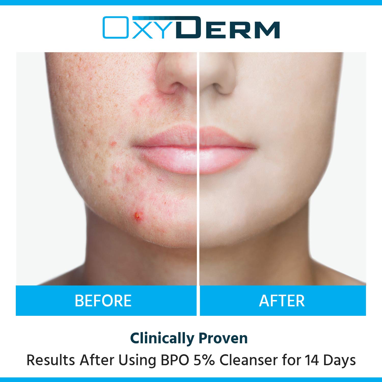 5% Benzoyl Peroxide Acne Face Wash - Clinically Proven Treatment for Cystic Breakouts, Oily Skin & Clogged Pores | Fights Blackheads, Whiteheads & Pimples | Gentle Daily Cleanser for Teens & Adults | Perfect for Morning & Night Skincare Routine