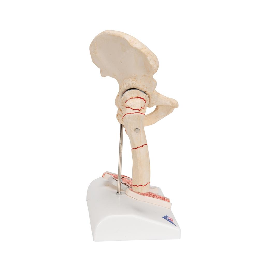 Femoral Fracture & Hip Osteoarthritis Anatomical Model - Medical Training, Student Education, and Clinical Demonstration Tool