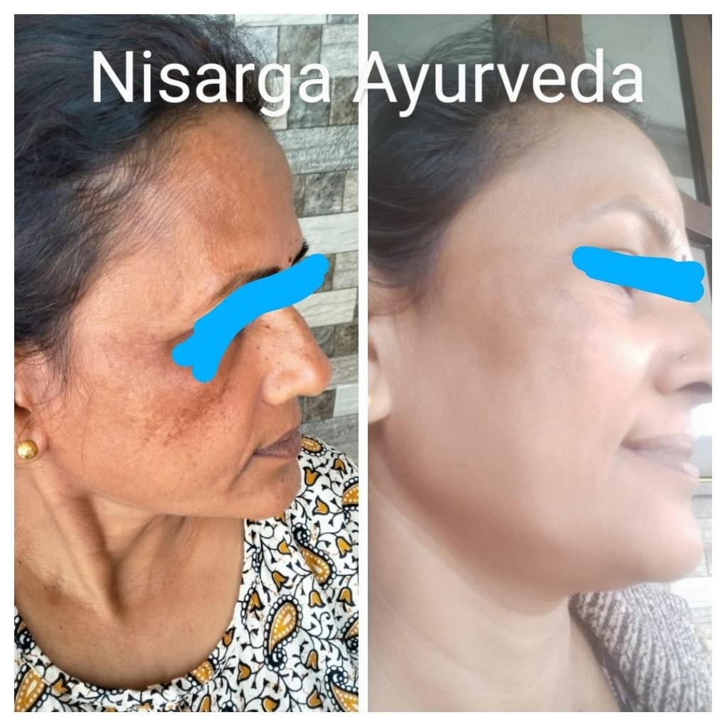 Nisarga Ayurveda Pigmentation Face Pack - Natural Treatment for Tanning, Melasma & Dark Spots, Reduces Scar Marks, UV Protection for Radiant Skin - Pack of 2 (100g Each) | Perfect for Daily Skincare & Sun Damage Repair