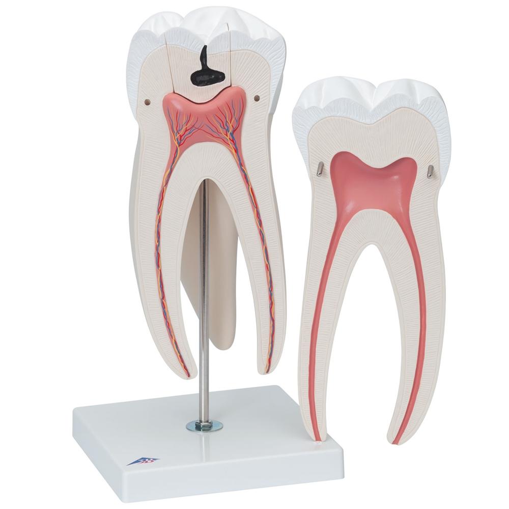 Giant Molar with Cavities - 15x Life Size Dental Model (5-Part) - Perfect for Dental Education, Classroom Demonstrations & Medical Training
