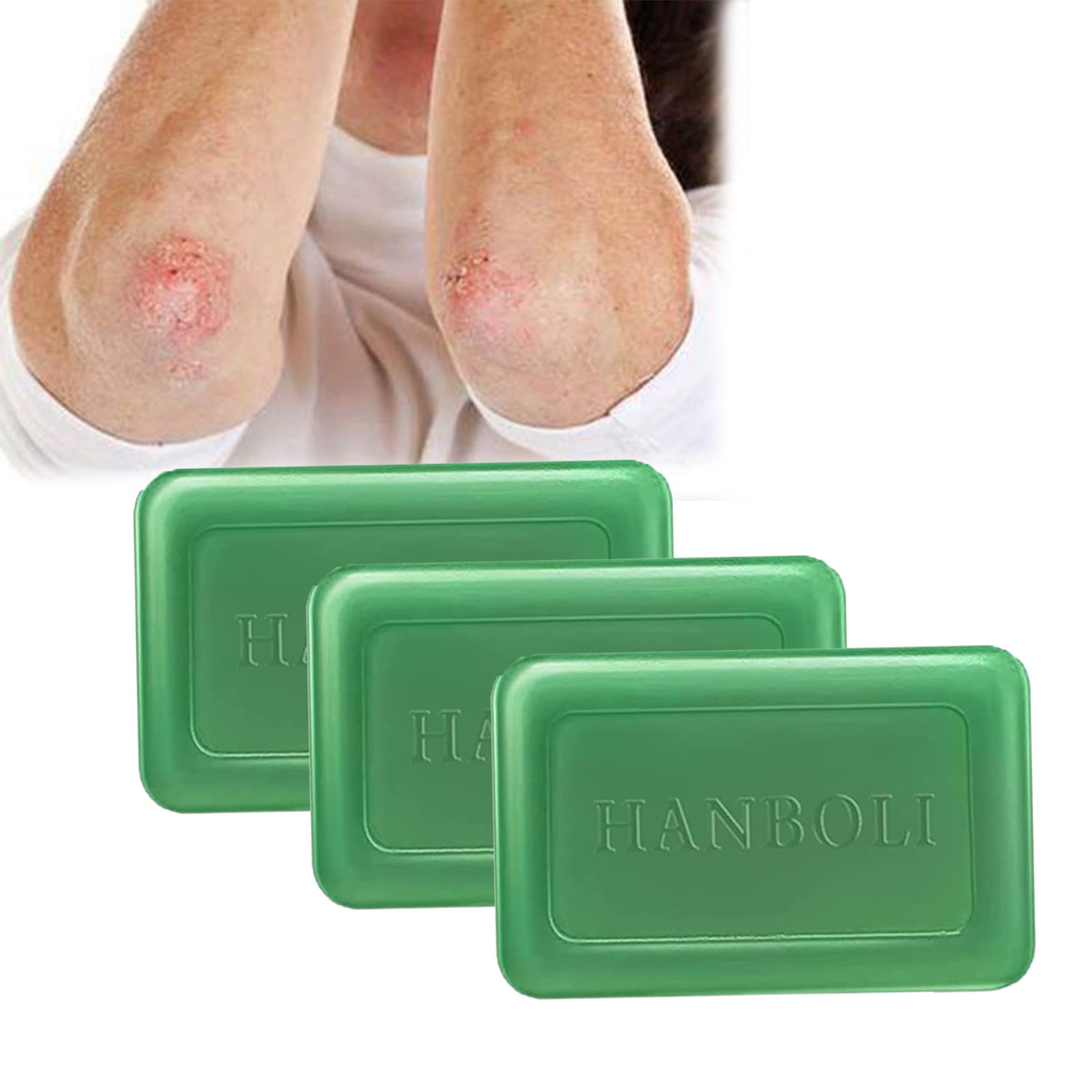 Natural Herbal Psoriasis Treatment Soap - Soothing & Moisturizing Eczema Relief (3 Pack) for Dry, Itchy Skin Care at Home | Perfect for Sensitive Skin & Daily Shower Use
