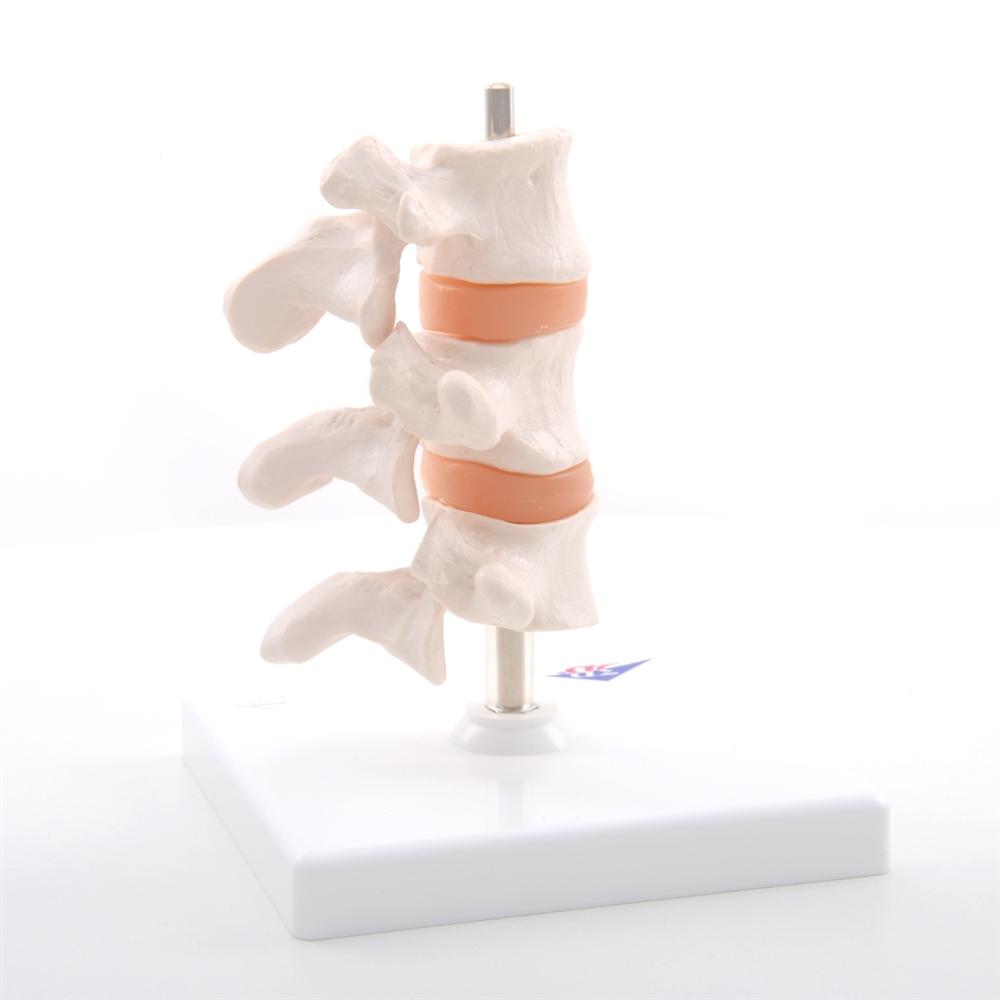 Premium Osteoporosis Bone Model - Anatomically Accurate Skeletal Display for Medical Education & Patient Demonstration - Perfect for Classrooms, Clinics, and Healthcare Training